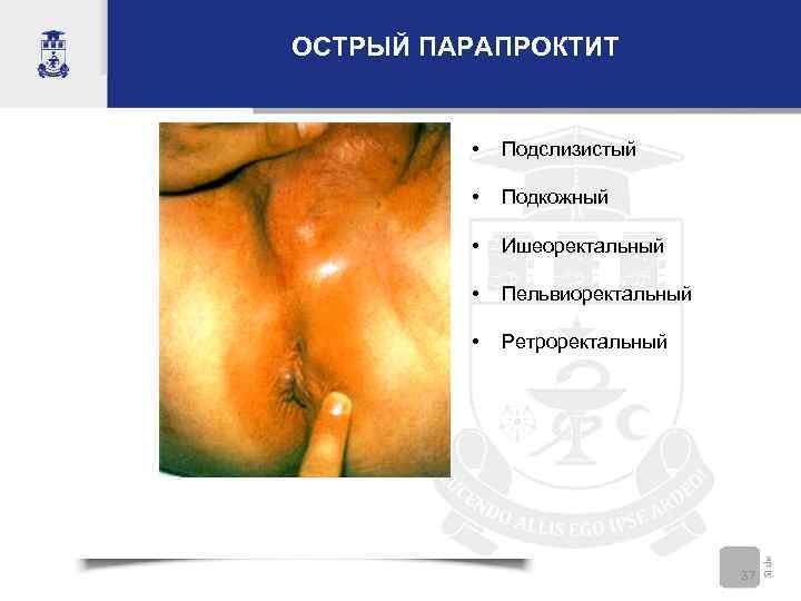 ОСТРЫЙ ПАРАПРОКТИТ   •  Подслизистый  •  Подкожный  • 