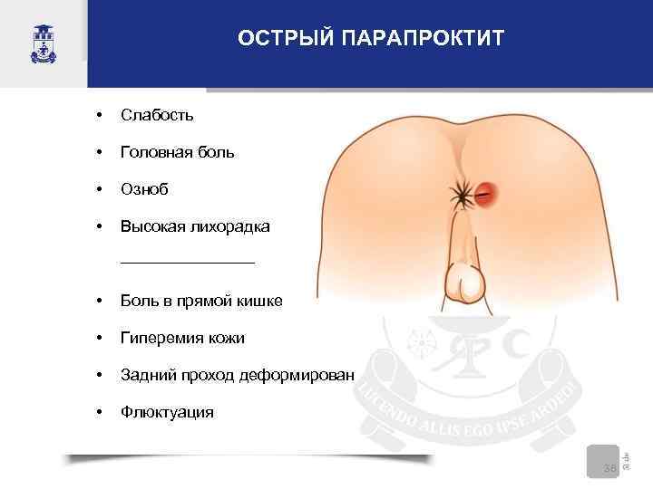     ОСТРЫЙ ПАРАПРОКТИТ  •  Слабость  •  Головная