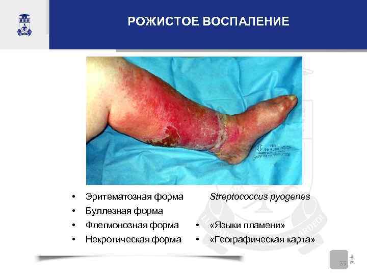   РОЖИСТОЕ ВОСПАЛЕНИЕ •  Эритематозная форма  Streptococcus pyogenes •  Буллезная