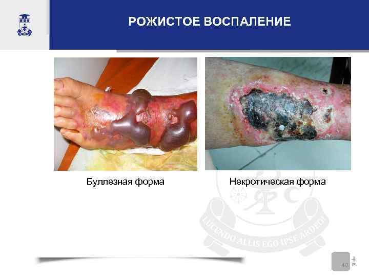   РОЖИСТОЕ ВОСПАЛЕНИЕ Буллезная форма  Некротическая форма     40