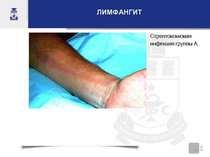 ЛИМФАНГИТ    Стрептококковая   инфекция группы А    