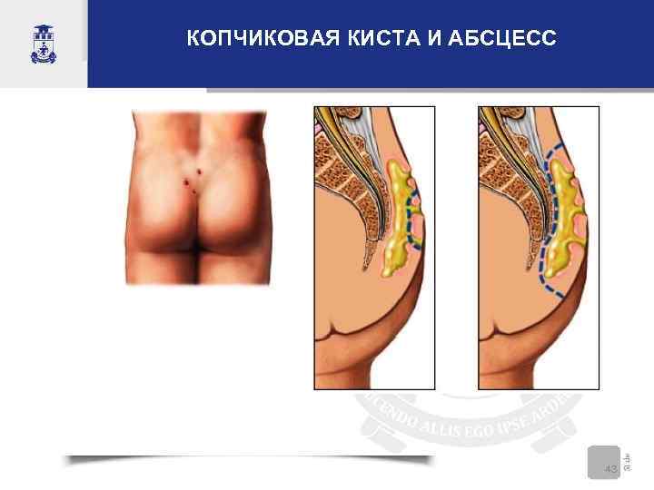 КОПЧИКОВАЯ КИСТА И АБСЦЕСС       43 