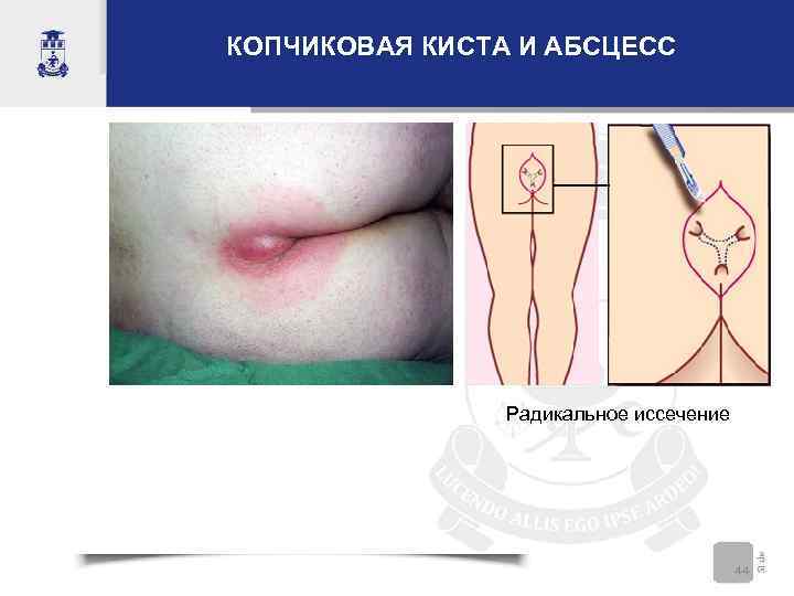 КОПЧИКОВАЯ КИСТА И АБСЦЕСС     Радикальное иссечение    