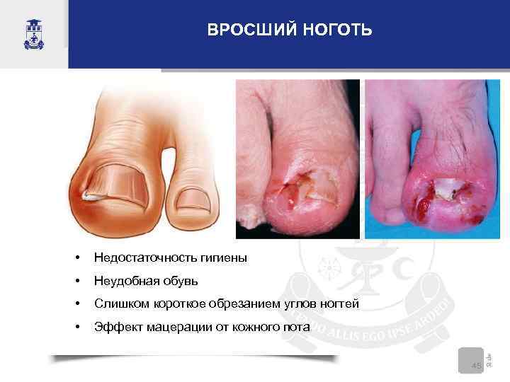      ВРОСШИЙ НОГОТЬ •  Недостаточность гигиены •  Неудобная