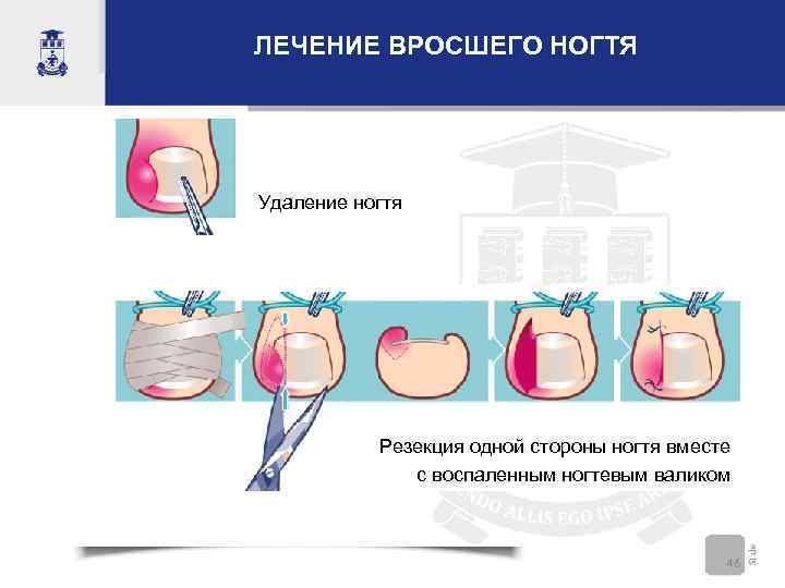 ЛЕЧЕНИЕ ВРОСШЕГО НОГТЯ Удаление ногтя    Резекция одной стороны ногтя вместе 