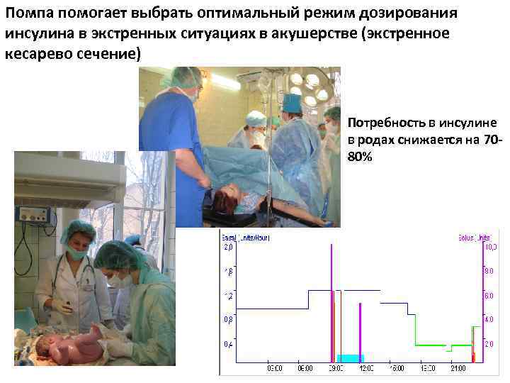 Помпа помогает выбрать оптимальный режим дозирования инсулина в экстренных ситуациях в акушерстве (экстренное кесарево