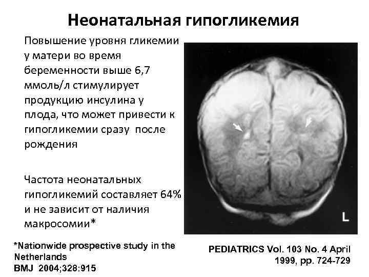   Неонатальная гипогликемия  Повышение уровня гликемии  у матери во время 
