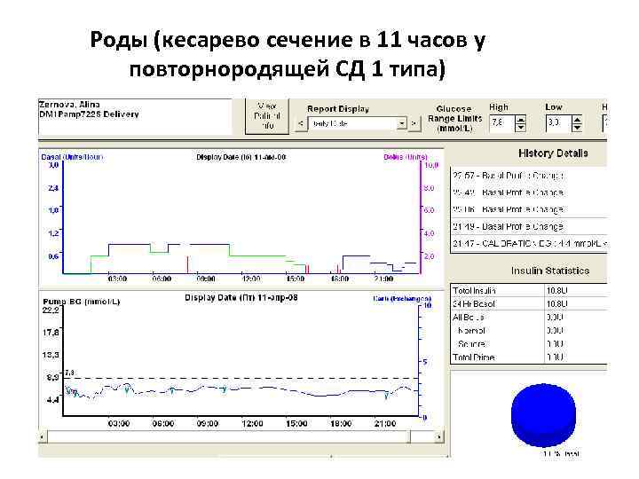 Роды (кесарево сечение в 11 часов у  повторнородящей СД 1 типа) 