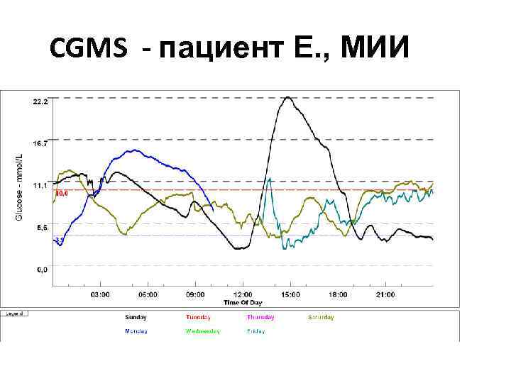 CGMS - пациент Е. , МИИ 