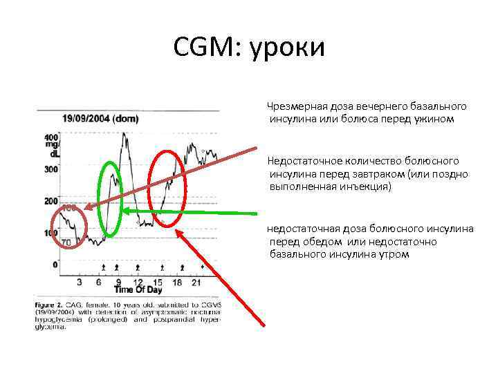 CGM: уроки  Чрезмерная доза вечернего базального  инсулина или болюса перед ужином 
