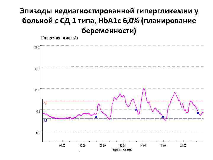 Эпизоды недиагностированной гипергликемии у больной с СД 1 типа, Hb. A 1 c 6,