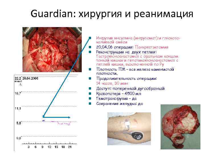 Guardian: хирургия и реанимация  n  Инфузия инсулина (инфузомат) и глюкозо-  