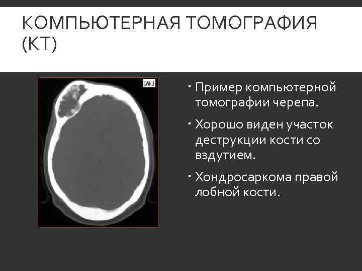 КОМПЬЮТЕРНАЯ ТОМОГРАФИЯ (КТ)    Пример компьютерной    томографии черепа. 