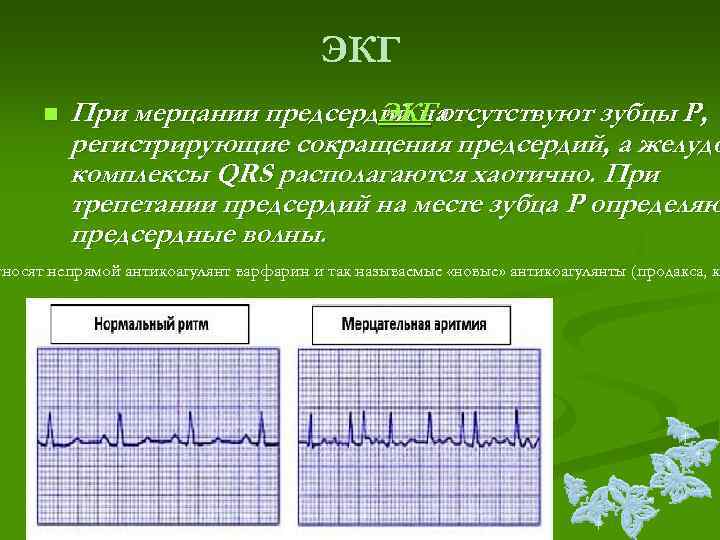        ЭКГ  n  При мерцании предсердий