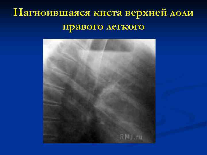 Нагноившаяся киста верхней доли  правого легкого 