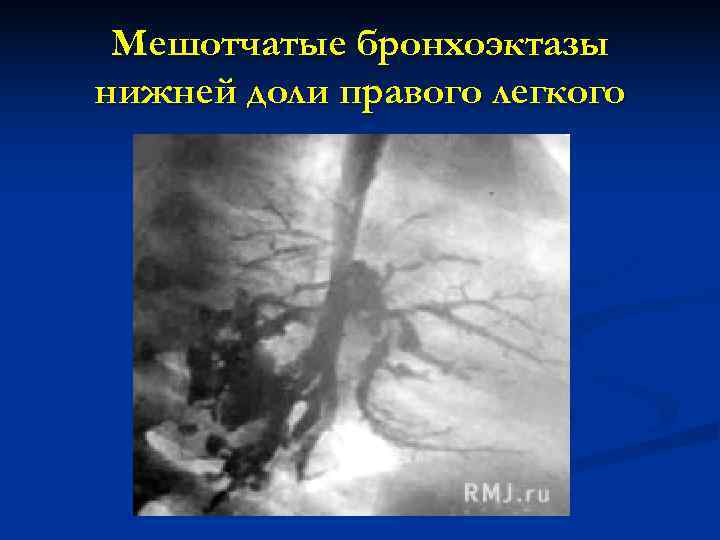  Мешотчатые бронхоэктазы нижней доли правого легкого 