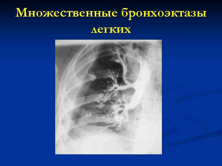 Множественные бронхоэктазы  легких 