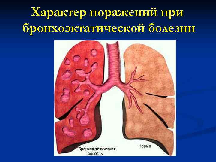  Характер поражений при бронхоэктатической болезни 