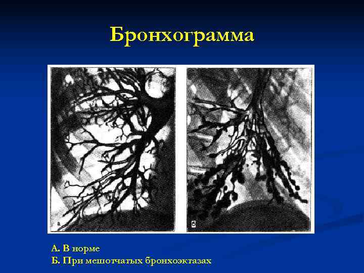 Приобретенные бронхоэктазы. Бронхоэктатическая болезнь (бронхоэктазы). Бронхоэктатическая болезнь бронхография. Мешотчатая форма бронхоэктатическая болезнь.