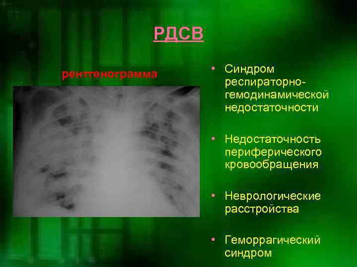    РДСВ рентгенограмма  • Синдром    респираторно-  