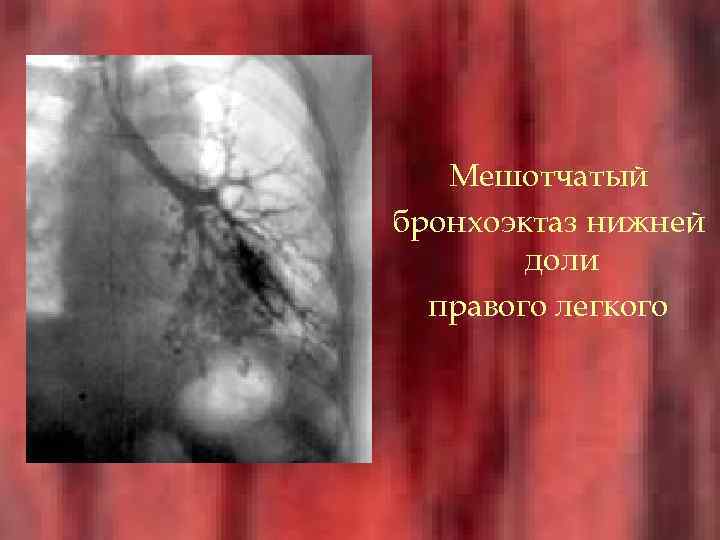   Мешотчатый бронхоэктаз нижней   доли  правого легкого 