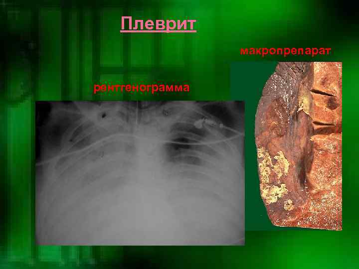   Плеврит   макропрепарат  рентгенограмма 