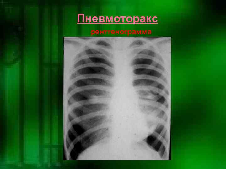 Пневмоторакс  рентгенограмма 