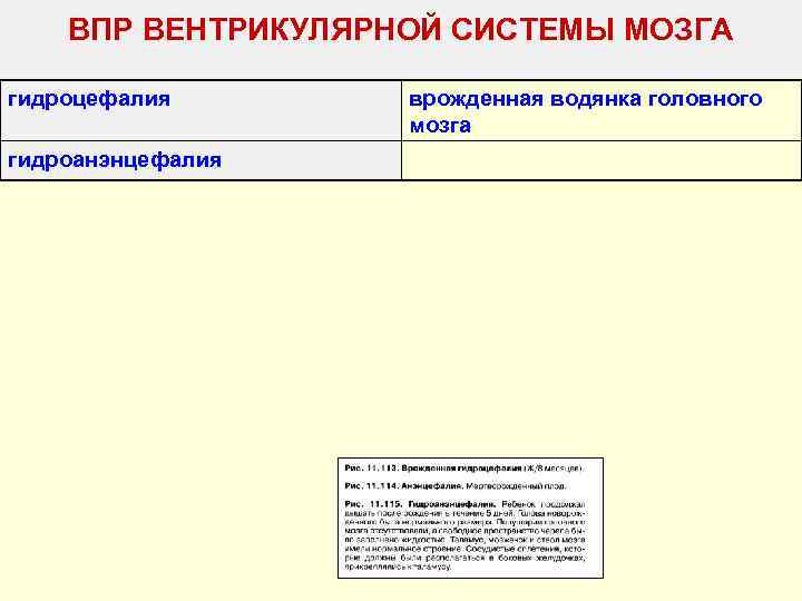   ВПР ВЕНТРИКУЛЯРНОЙ СИСТЕМЫ МОЗГА гидроцефалия  врожденная водянка головного   