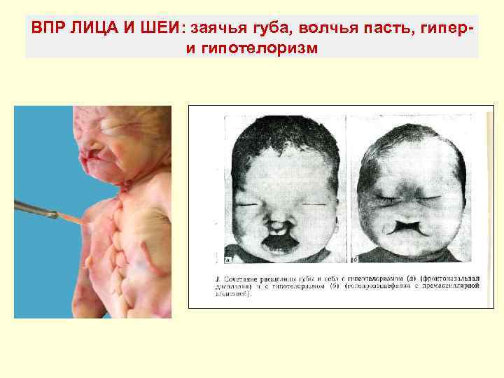 Врожденные пороки развития картинки