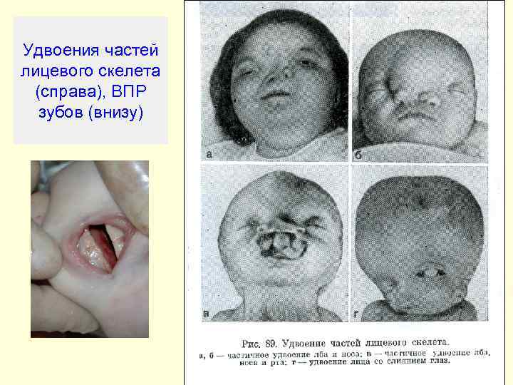 Удвоения частей лицевого скелета (справа), ВПР  зубов (внизу) 