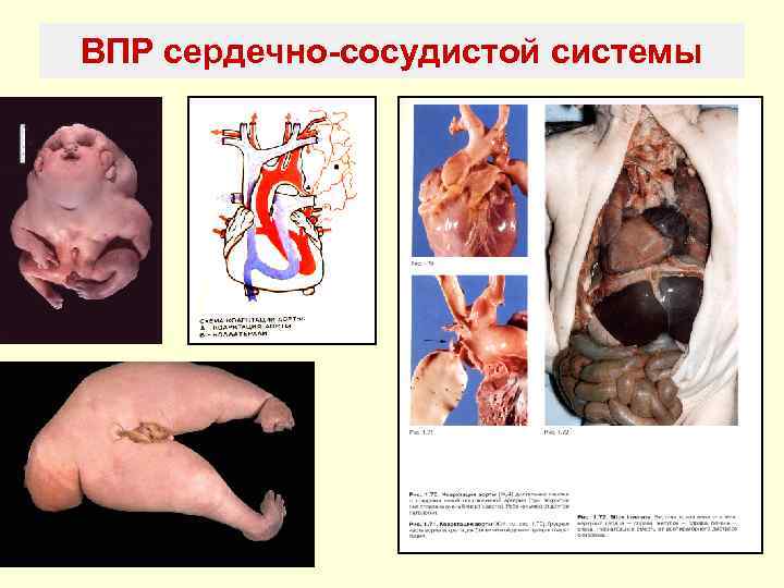 ВПР сердечно-сосудистой системы 