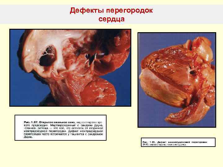 Дефекты перегородок  сердца 