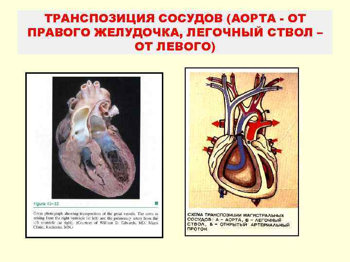 Транспозиция артерий. Транспозиция желудочков. Транспозиция аорты. Транспозиция аорты и легочного ствола. Транспозиция аорты и легочной артерии.