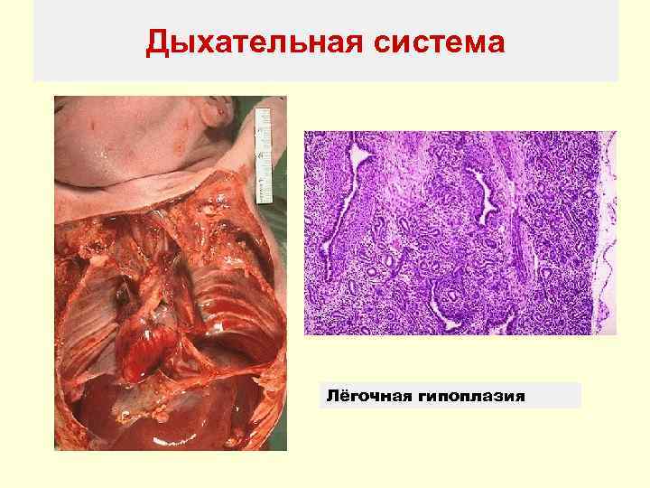 Дыхательная система   Лёгочная гипоплазия 
