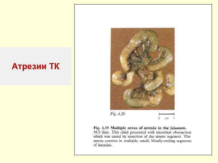 Атрезии ТК 