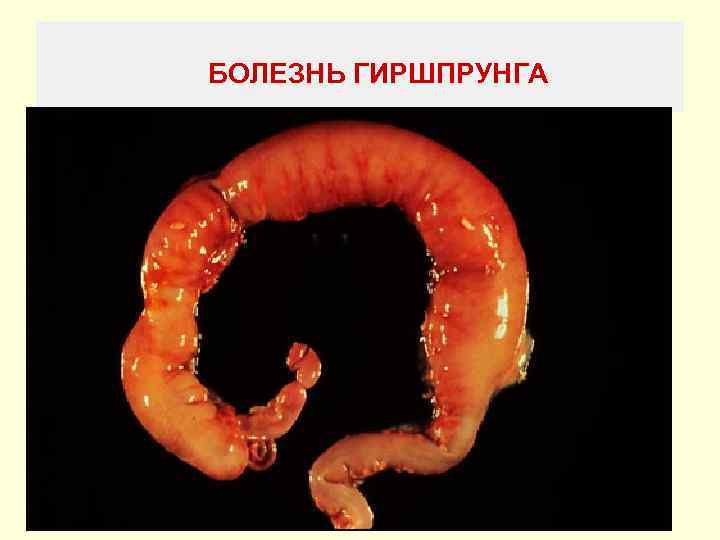 БОЛЕЗНЬ ГИРШПРУНГА 