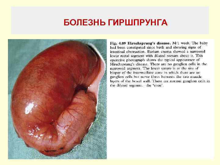 БОЛЕЗНЬ ГИРШПРУНГА 