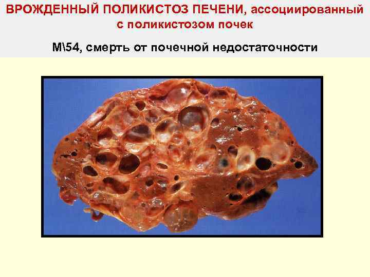 ВРОЖДЕННЫЙ ПОЛИКИСТОЗ ПЕЧЕНИ, ассоциированный   с поликистозом почек М54, смерть от почечной недостаточности