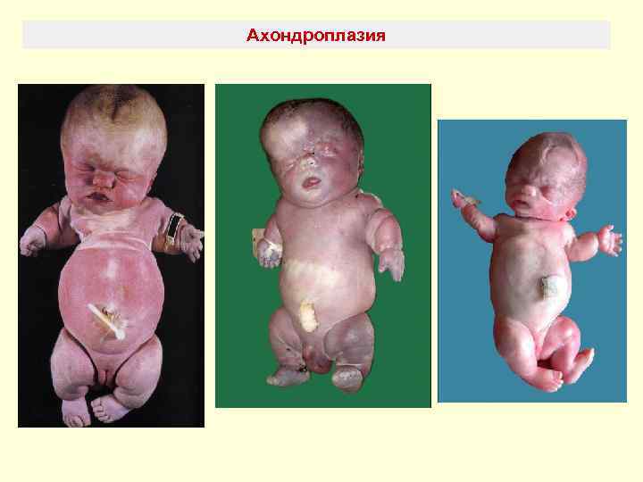 Ахондроплазия 