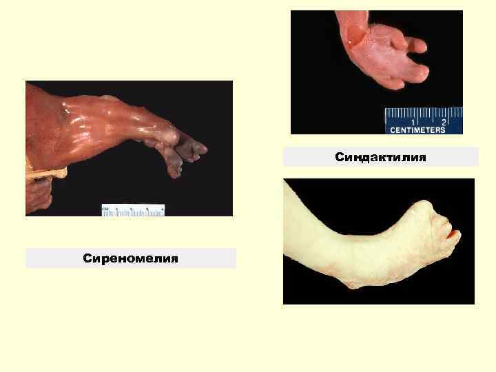   Синдактилия Сиреномелия 