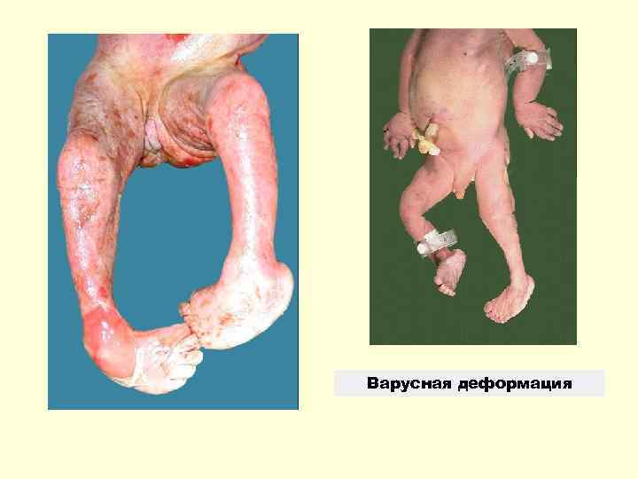 Варусная деформация 