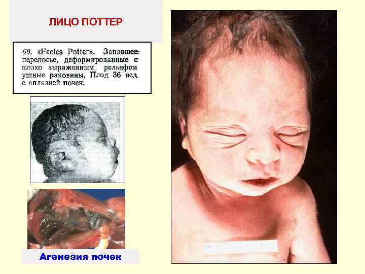  ЛИЦО ПОТТЕР Агенезия почек 