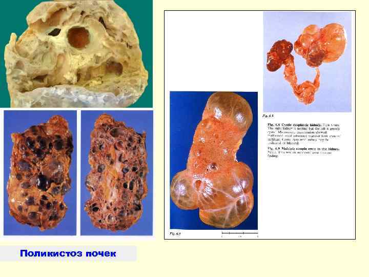 Поликистоз почек 