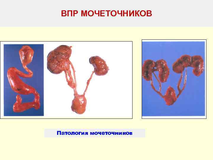 ВПР МОЧЕТОЧНИКОВ Патология мочеточников 