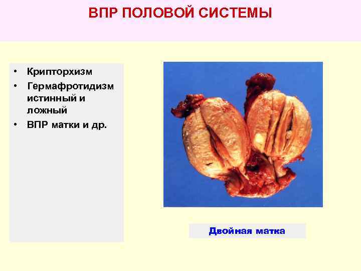   ВПР ПОЛОВОЙ СИСТЕМЫ • Крипторхизм • Гермафротидизм  истинный и  ложный