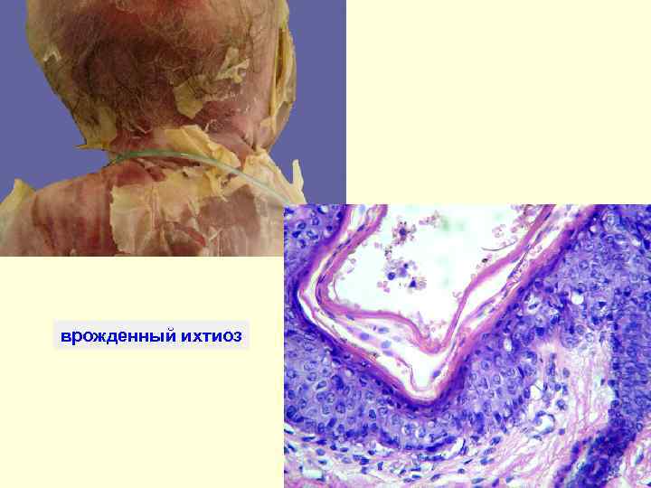 врожденный ихтиоз 