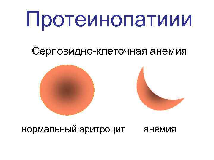 Протеинопатиии Серповидно-клеточная анемия нормальный эритроцит  анемия 