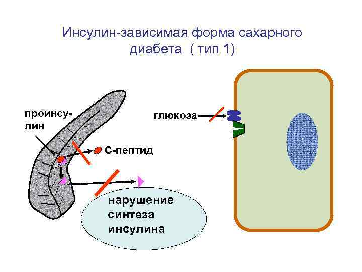 Инсулин-зависимая форма сахарного    диабета ( тип 1)  проинсу- 