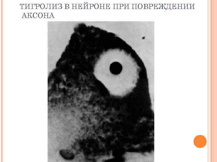 ТИГРОЛИЗ В НЕЙРОНЕ ПРИ ПОВРЕЖДЕНИИ АКСОНА 