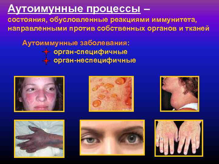 Аутоимунные процессы – состояния, обусловленные реакциями иммунитета, направленными против собственных органов и тканей 